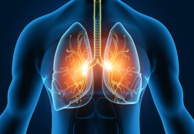 Non-Tuberculous Mycobacterial Pulmonary Disease
