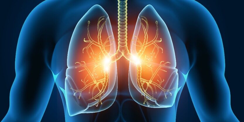 Nontuberculous mycobacteria lung disease